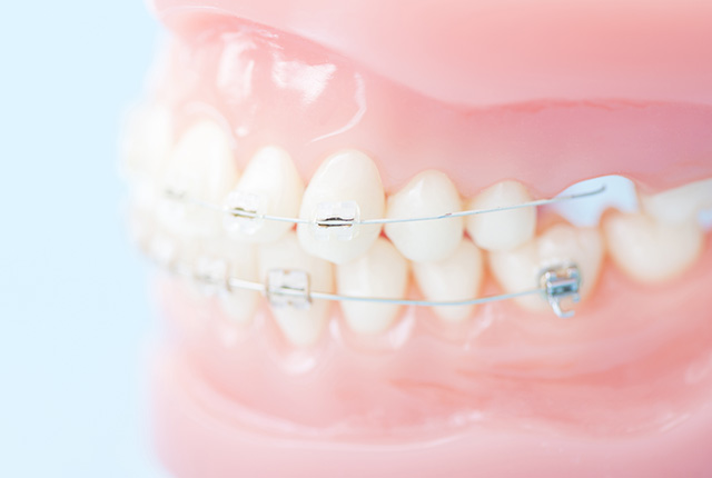 ワイヤー矯正された歯の模型